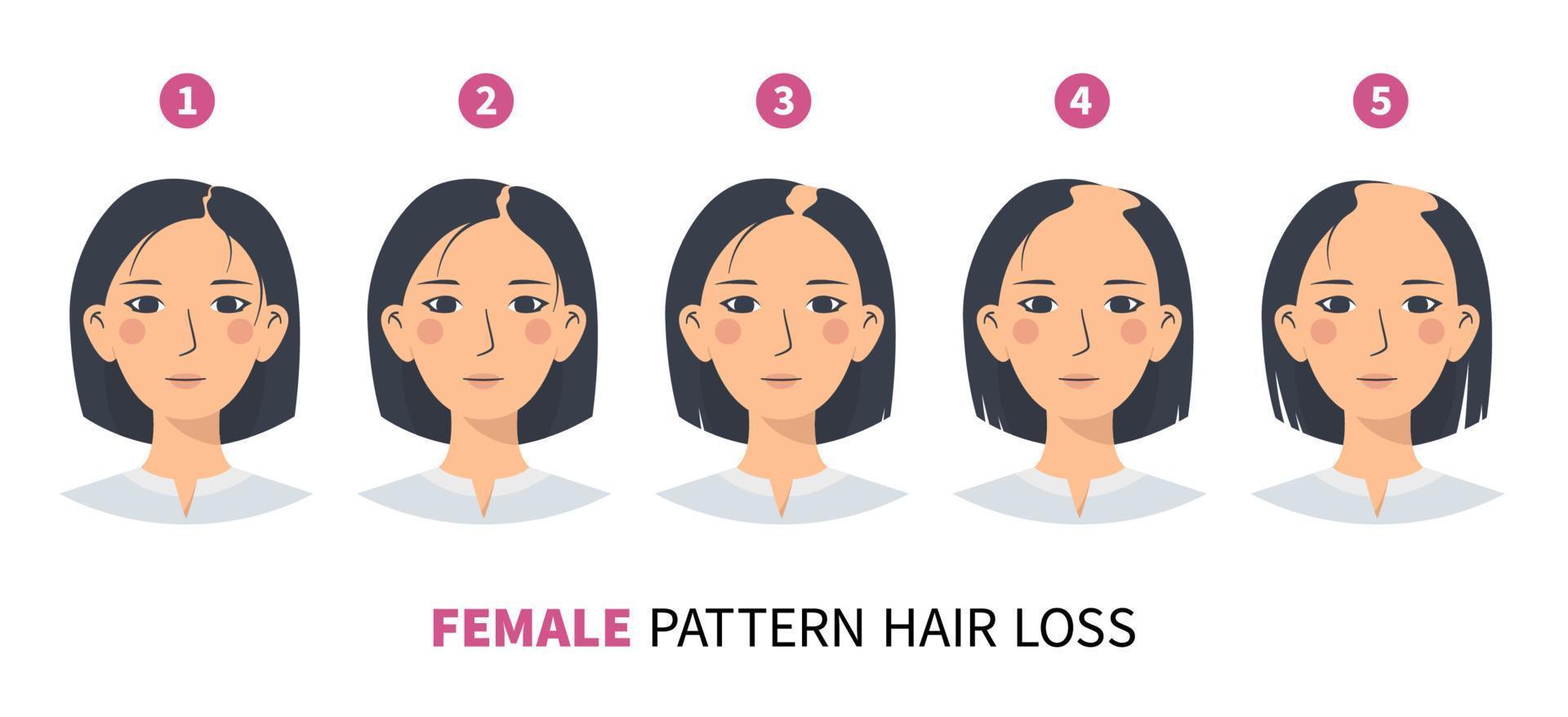 hair-loss-stages-androgenetic-alopecia-female-pattern-fphl-steps-of-baldness-infographic-in-a-flat-style-with-a-woman-vector