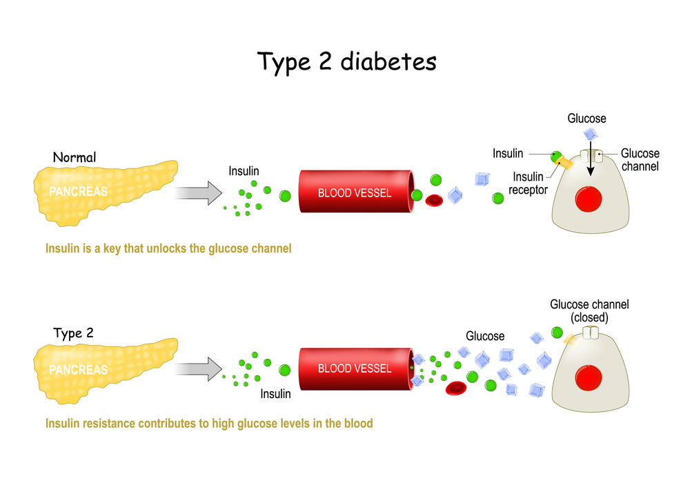 Types,2,Of,Diabetes,Mellitus.,Comparison,Of,Cell,Work,In